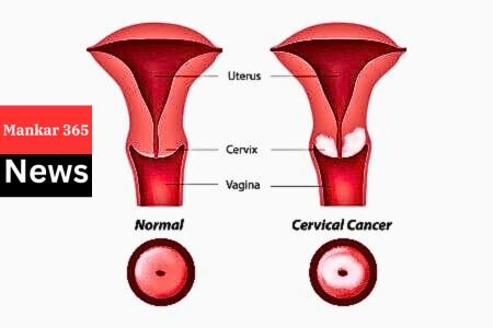 Cervical Cancer क्या होता है, कैसे बचे? Poonam Pandey Deth News  Cervical Cancer:-  महिलाओ को होने वाला सबसे आम कैंसर में से दूसरे नंबर पर आता है . ये इतना आम है कि आप के आस पास के रिश्तेदार, कलिग, दोस्त, या खुद आप के घर में भी हो सकता है या ये बात उन्हें खुद मालूम ना हो। या उसका कारण है जानकारी की कमी या शर्म।